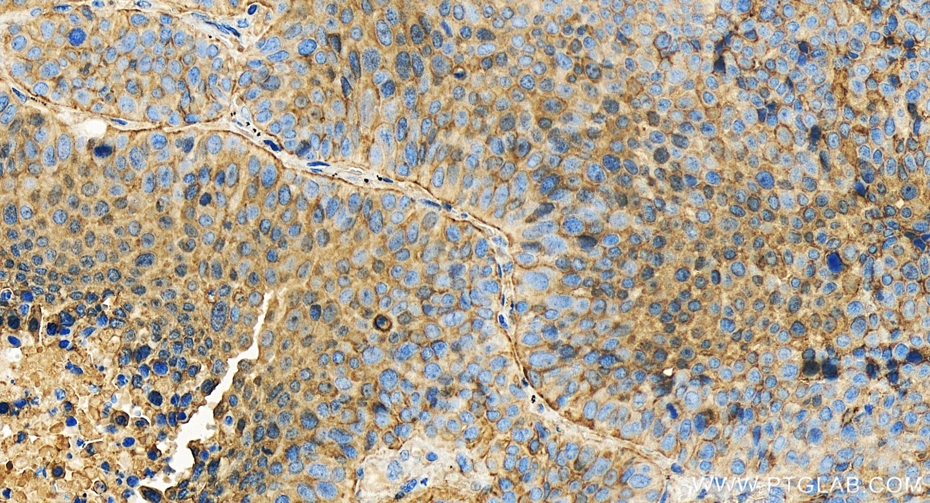 Immunohistochemistry (IHC) staining of human lung cancer tissue using NDRG1 Recombinant antibody (85141-4-RR)