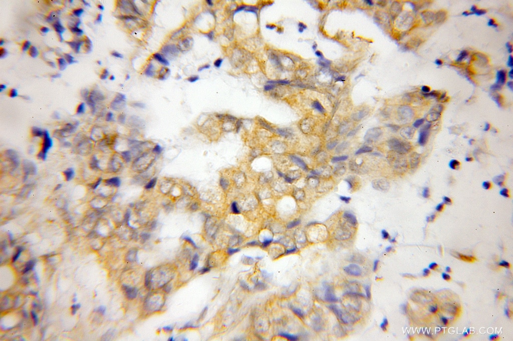 Immunohistochemistry (IHC) staining of human pancreas cancer tissue using NDRG2 Polyclonal antibody (12015-1-AP)