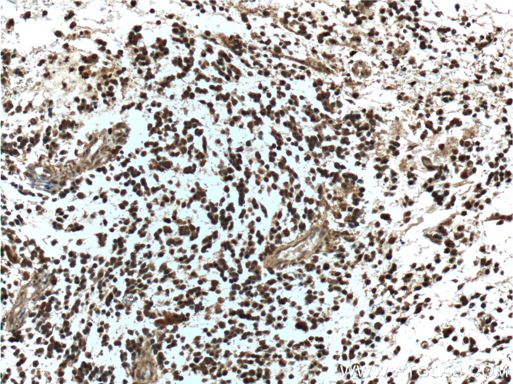 IHC staining of human gliomas using 12184-1-AP