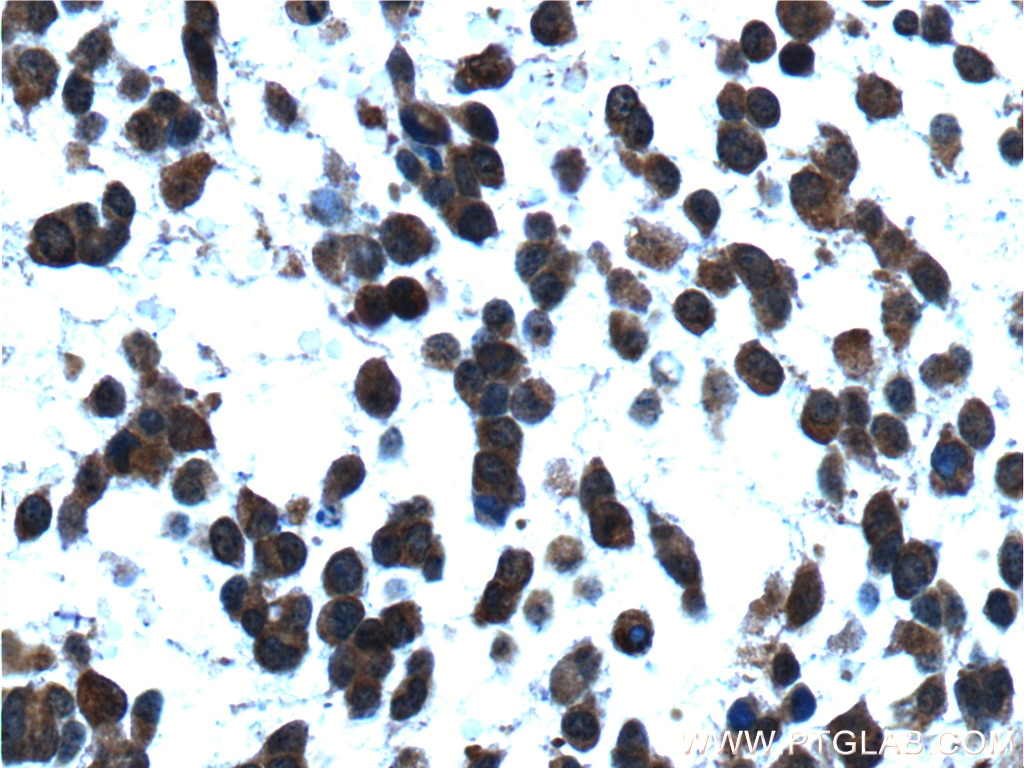 Immunohistochemistry (IHC) staining of human gliomas tissue using NDRG4 Polyclonal antibody (12184-1-AP)