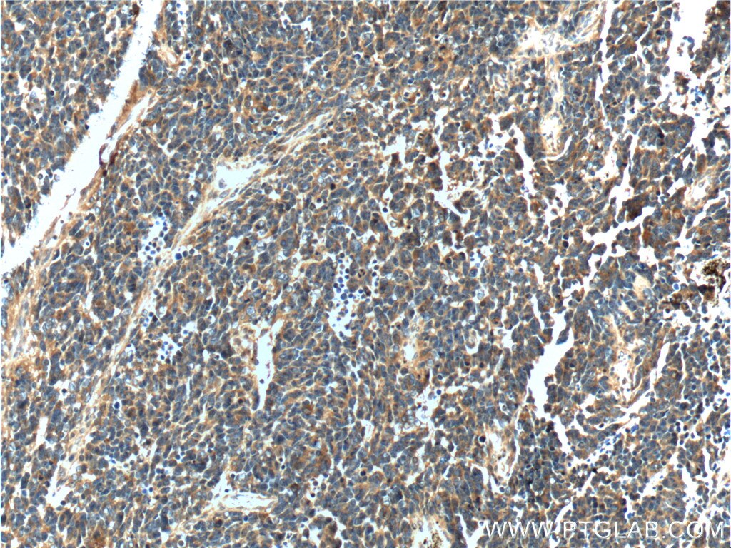 Immunohistochemistry (IHC) staining of human medulloblastoma tissue using NDRG4 Polyclonal antibody (12184-1-AP)