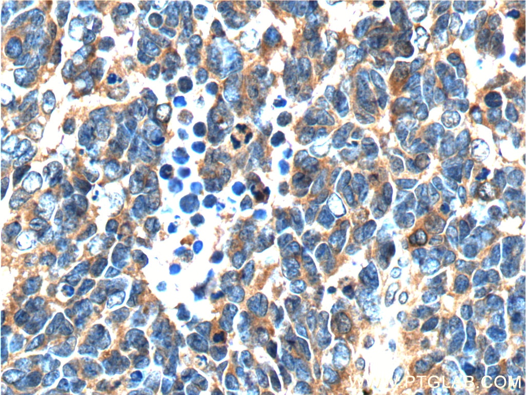 Immunohistochemistry (IHC) staining of human medulloblastoma tissue using NDRG4 Polyclonal antibody (12184-1-AP)