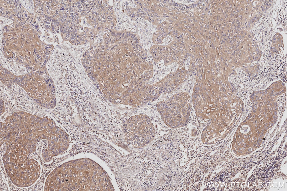 Immunohistochemistry (IHC) staining of human lung cancer tissue using NDRG4 Polyclonal antibody (12184-1-AP)