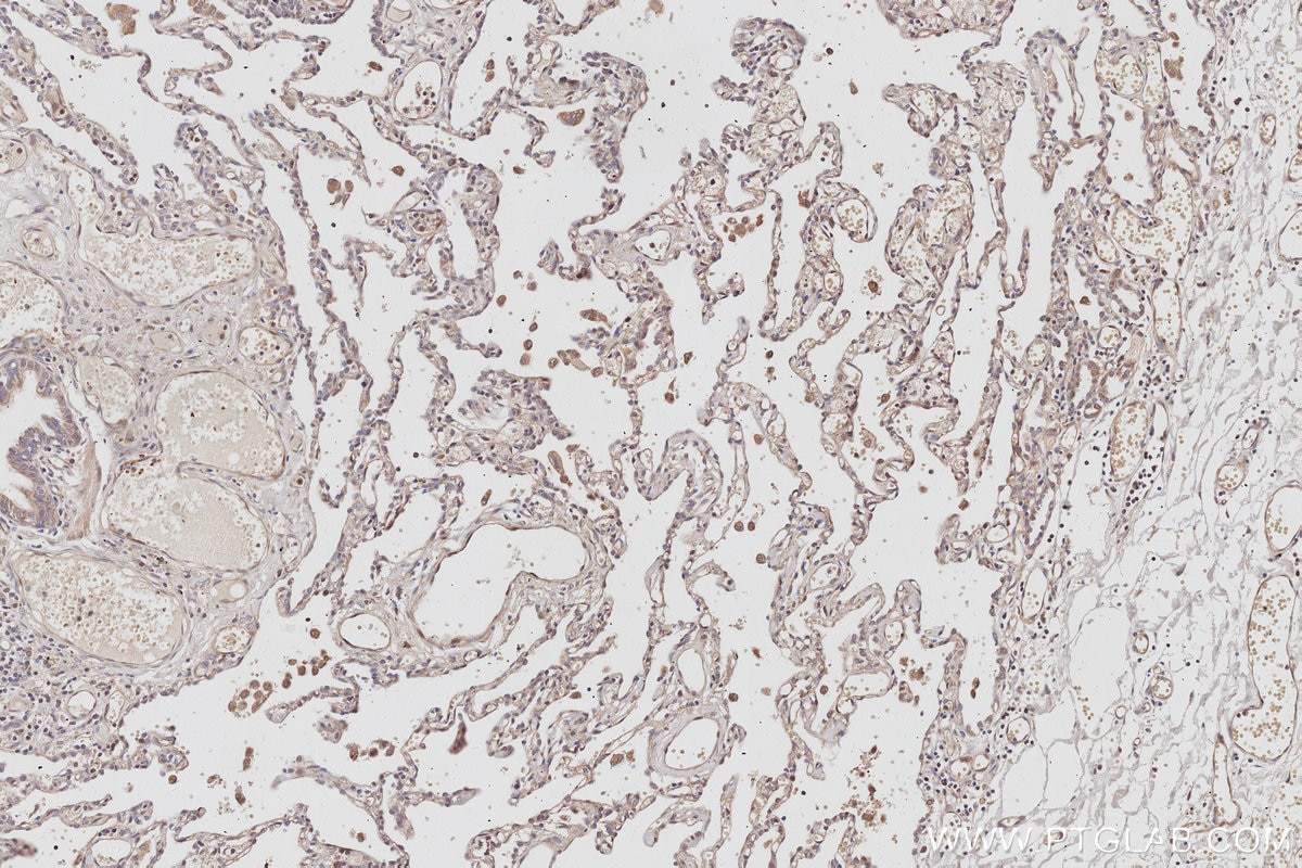 Immunohistochemistry (IHC) staining of human lung cancer tissue using NDRG4 Polyclonal antibody (12184-1-AP)