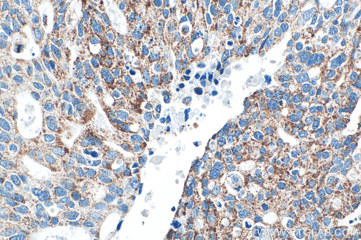 IHC staining of human ovary tumor using 32947-1-AP Immunohistochemistry (IHC) staining of human ovary tumor tissue using NDUFA10 Polyclonal antibody (32947-1-AP)