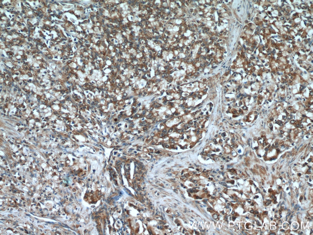 Immunohistochemistry (IHC) staining of human prostate cancer tissue using GRIM19 Polyclonal antibody (10986-1-AP)