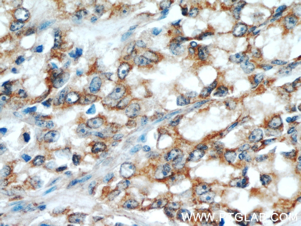 Immunohistochemistry (IHC) staining of human prostate cancer tissue using GRIM19 Polyclonal antibody (10986-1-AP)