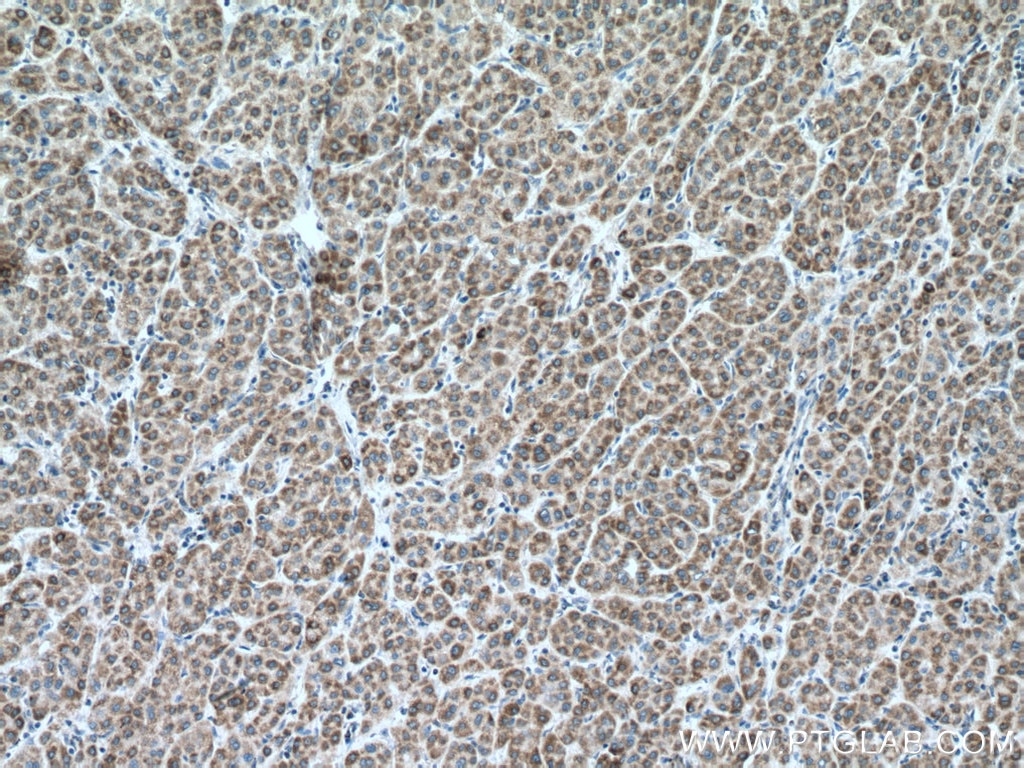 Immunohistochemistry (IHC) staining of human liver cancer tissue using NDUFA4L2 Polyclonal antibody (16480-1-AP)