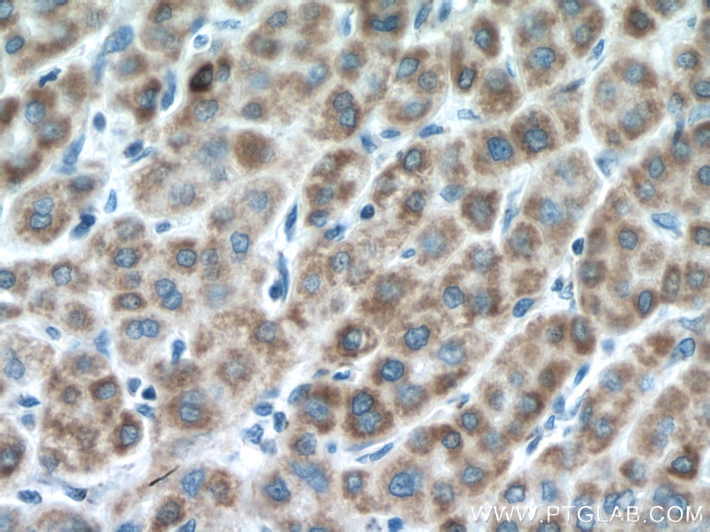 Immunohistochemistry (IHC) staining of human liver cancer tissue using NDUFA4L2 Polyclonal antibody (16480-1-AP)