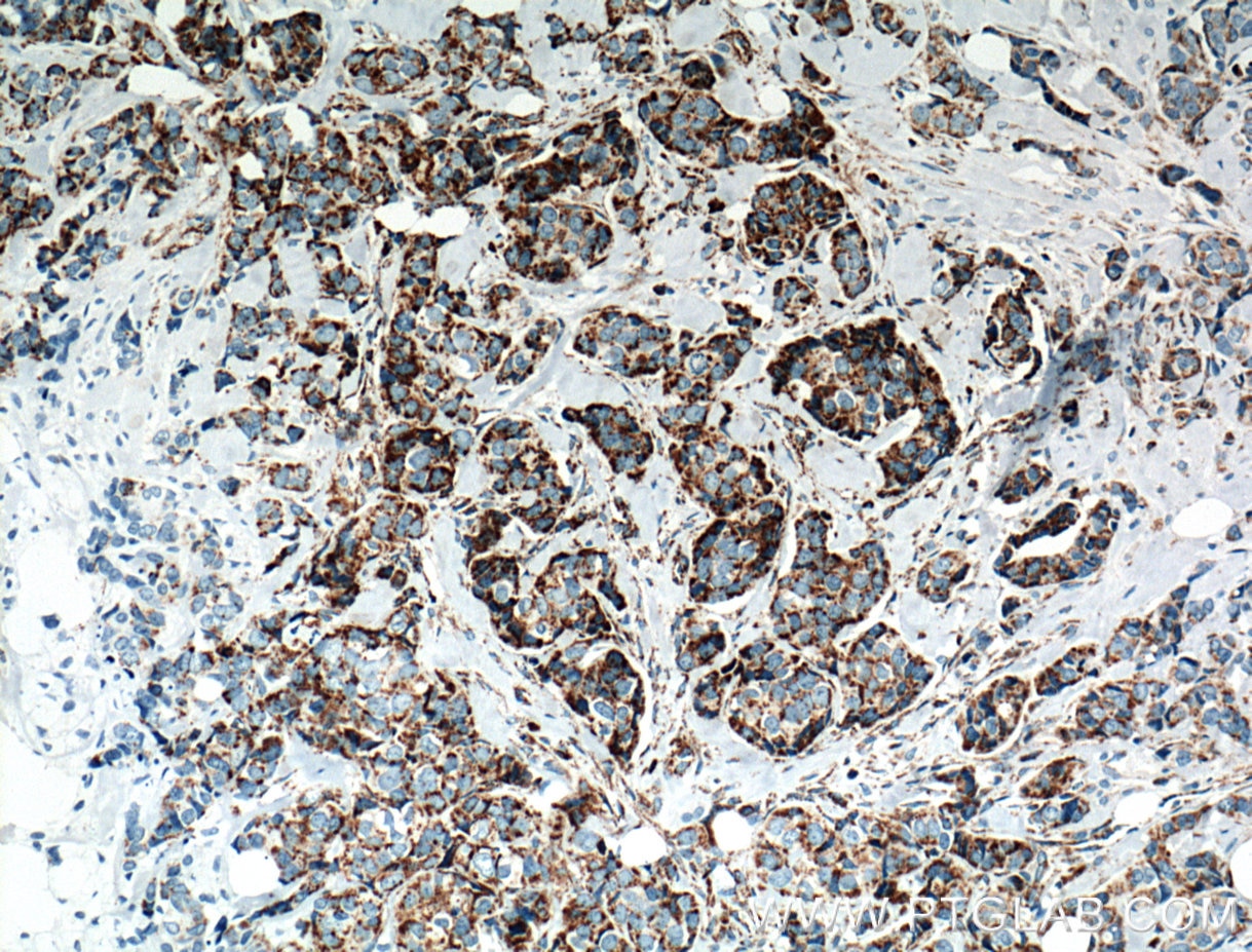 Immunohistochemistry (IHC) staining of human breast cancer tissue using NDUFA4L2 Monoclonal antibody (66050-1-Ig)