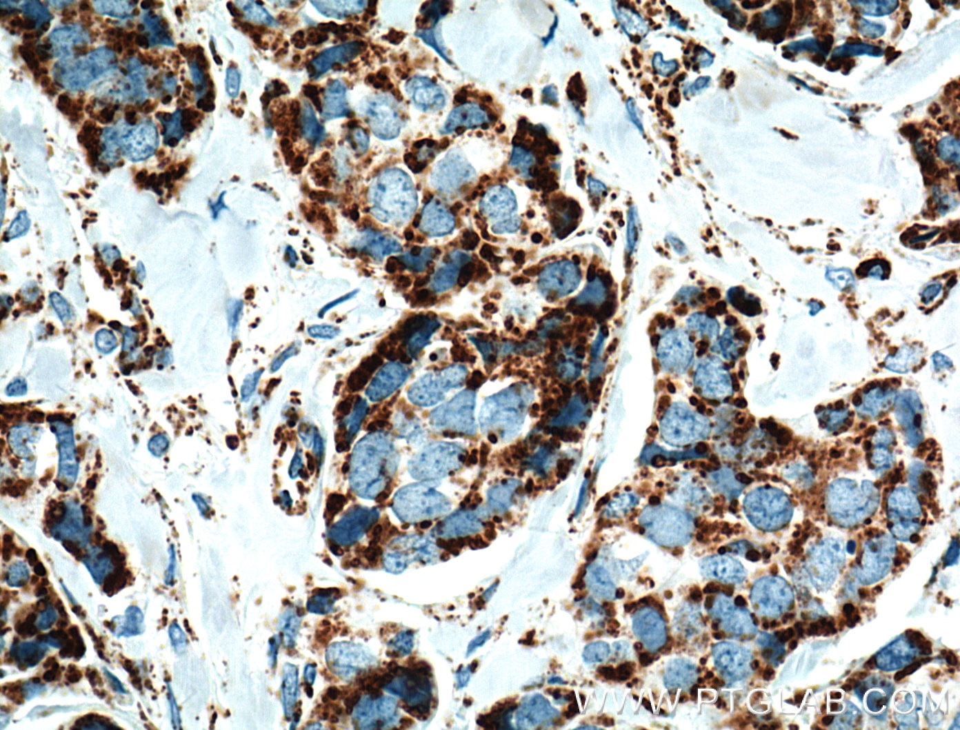 Immunohistochemistry (IHC) staining of human breast cancer tissue using NDUFA4L2 Monoclonal antibody (66050-1-Ig)