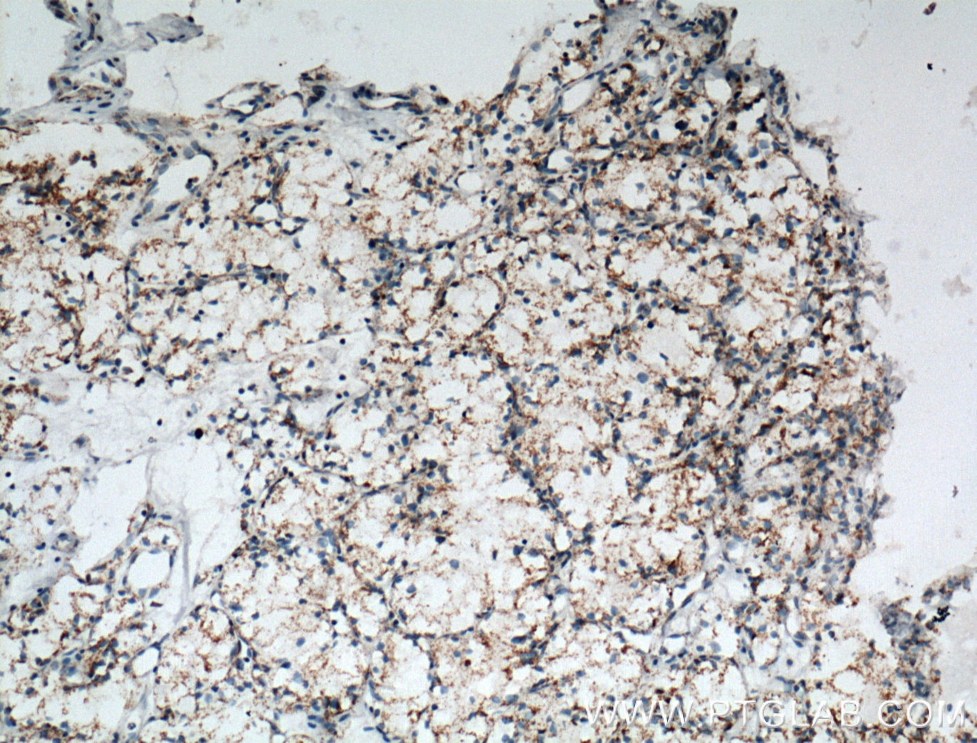 Immunohistochemistry (IHC) staining of human renal cell carcinoma tissue using NDUFA4L2 Monoclonal antibody (66050-1-Ig)