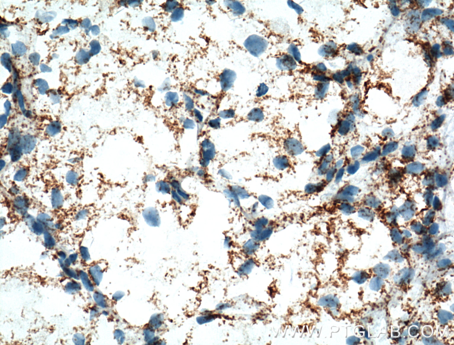 Immunohistochemistry (IHC) staining of human renal cell carcinoma tissue using NDUFA4L2 Monoclonal antibody (66050-1-Ig)