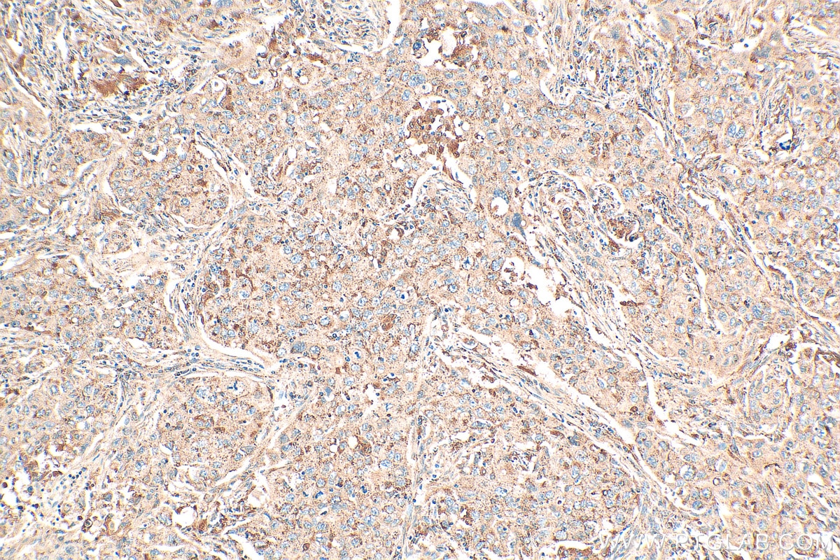 Immunohistochemistry (IHC) staining of human lung cancer tissue using NDUFA6 Polyclonal antibody (15445-1-AP)