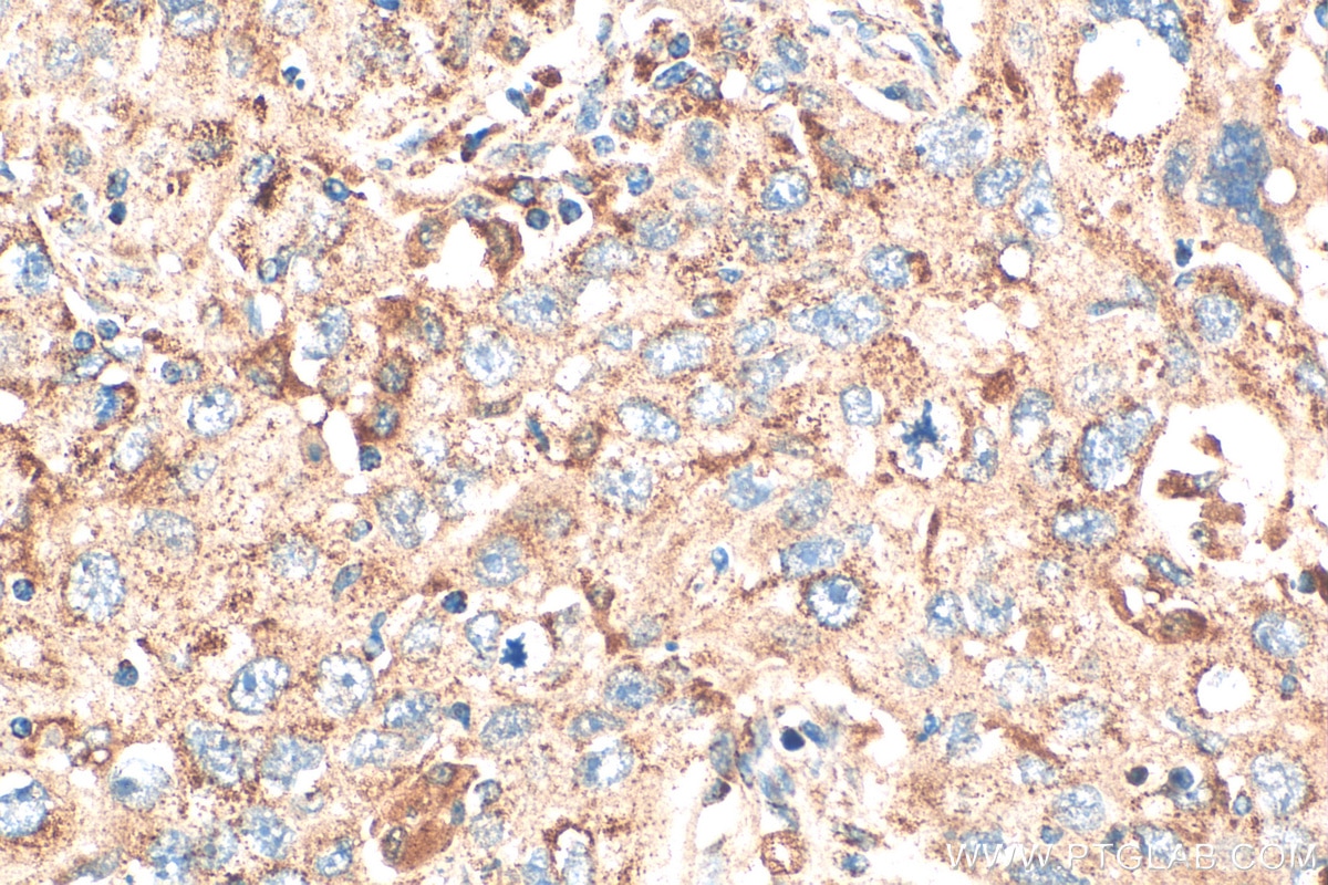 Immunohistochemistry (IHC) staining of human lung cancer tissue using NDUFA6 Polyclonal antibody (15445-1-AP)