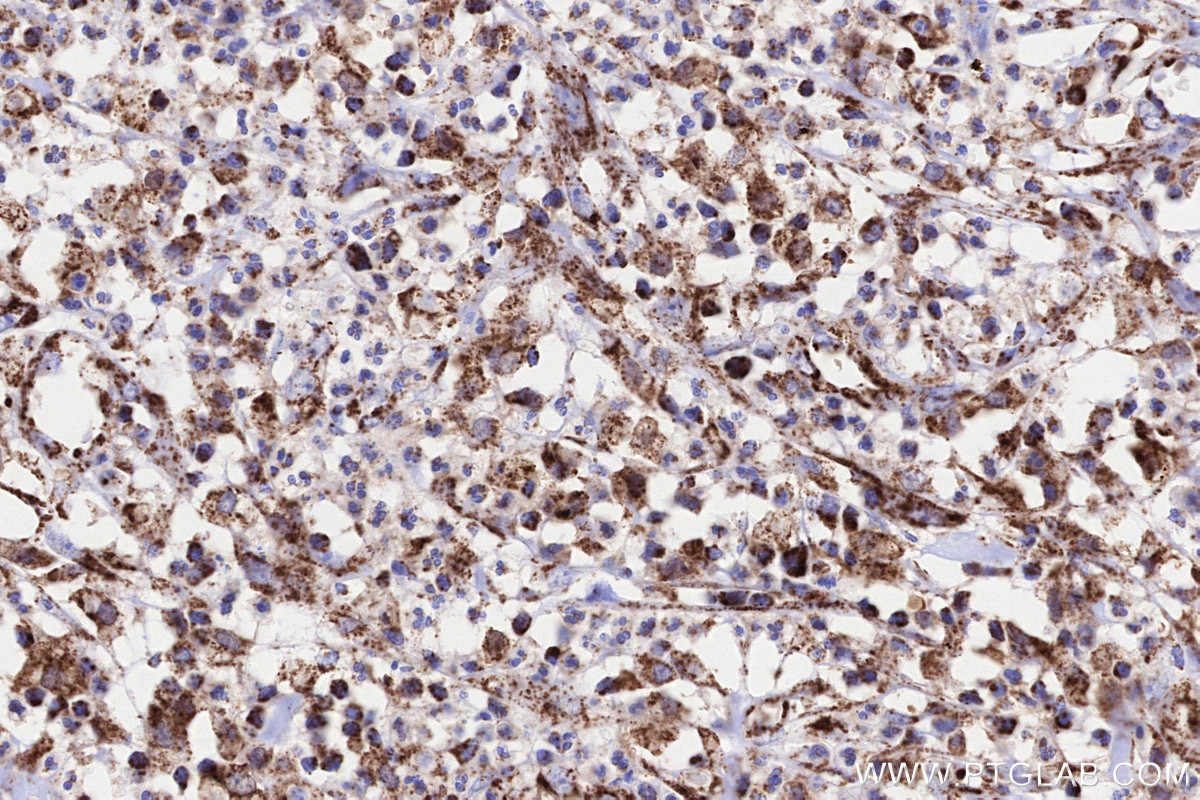 Immunohistochemistry (IHC) staining of human colon cancer tissue using NDUFA8 Polyclonal antibody (15064-1-AP)