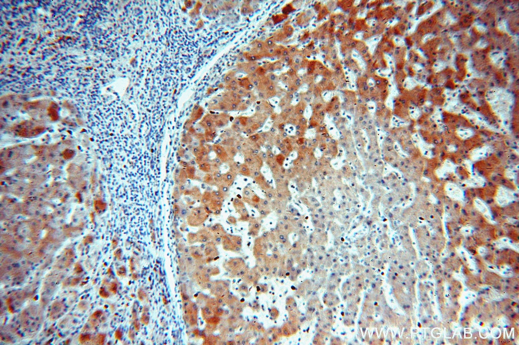 Immunohistochemistry (IHC) staining of human hepatocirrhosis tissue using NDUFA9 Polyclonal antibody (20312-1-AP)