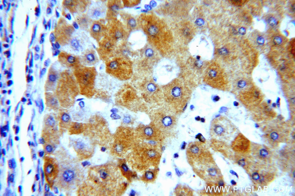 Immunohistochemistry (IHC) staining of human hepatocirrhosis tissue using NDUFA9 Polyclonal antibody (20312-1-AP)