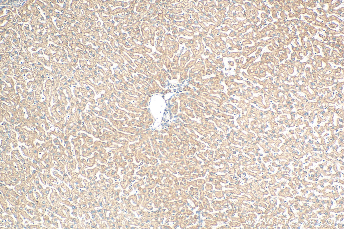 Immunohistochemistry (IHC) staining of human hepatocirrhosis tissue using NDUFA9 Polyclonal antibody (29621-1-AP)