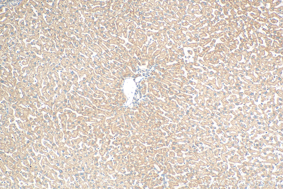 IHC staining of human hepatocirrhosis using 29621-1-AP