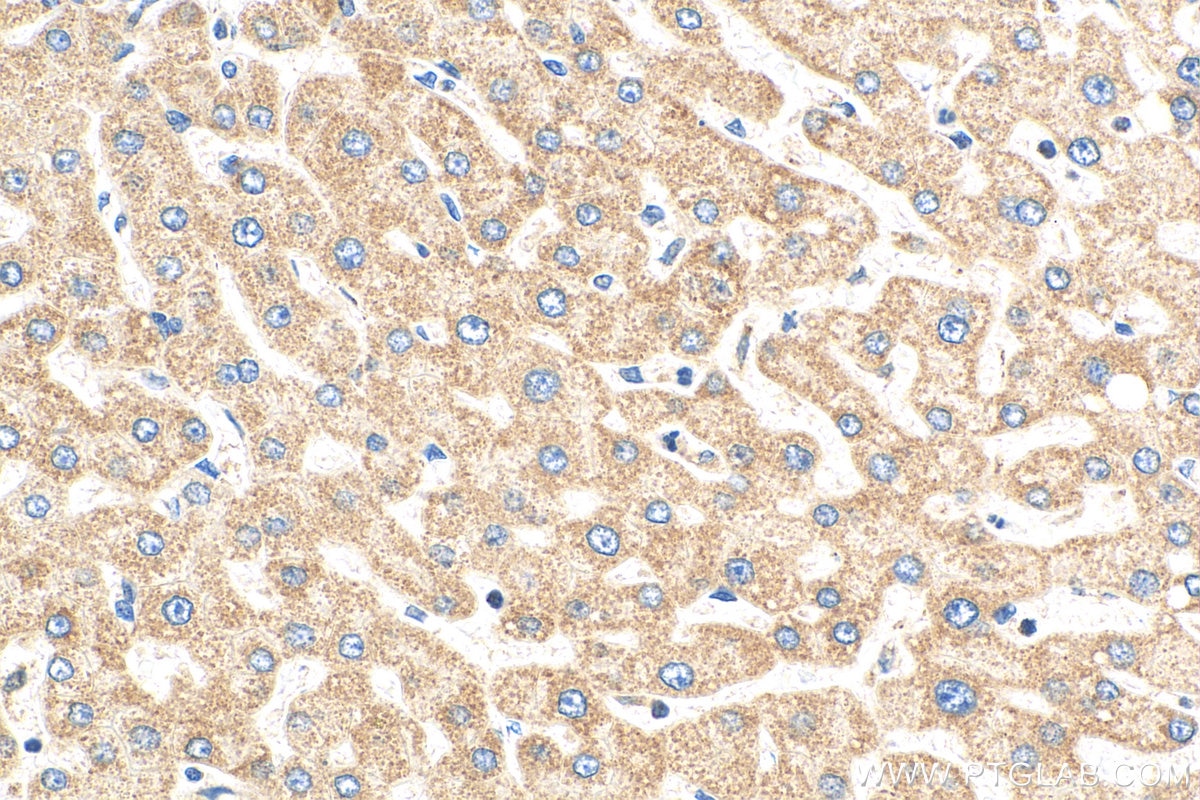 Immunohistochemistry (IHC) staining of human hepatocirrhosis tissue using NDUFA9 Polyclonal antibody (29621-1-AP)