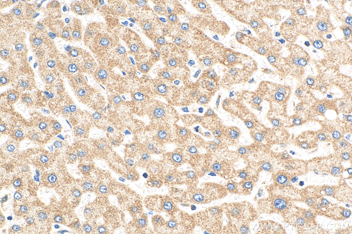 IHC staining of human hepatocirrhosis using 29621-1-AP