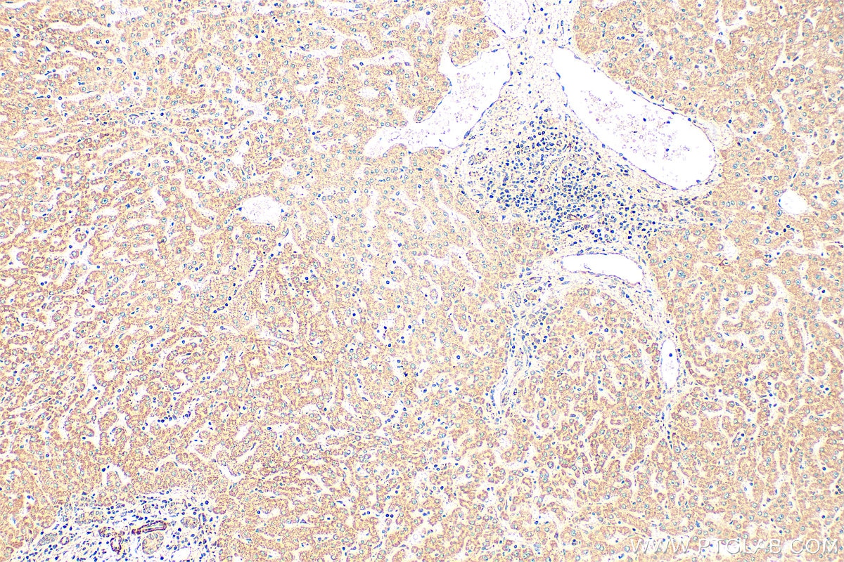 Immunohistochemistry (IHC) staining of human hepatocirrhosis tissue using NDUFA9 Polyclonal antibody (29621-1-AP)