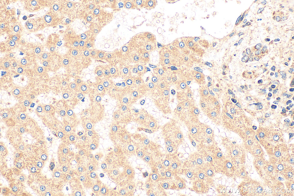 Immunohistochemistry (IHC) staining of human hepatocirrhosis tissue using NDUFA9 Polyclonal antibody (29621-1-AP)