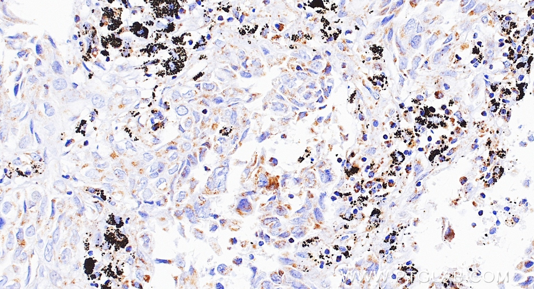 IHC staining of Human lung cancer (Adenocarcinoma) using 87143-2-RR Immunohistochemistry (IHC) staining of Human lung cancer (Adenocarcinoma) using NDUFA9 Recombinant monoclonal antibody (87143-2-RR)