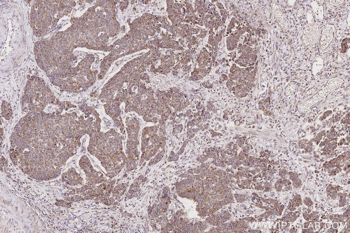 Immunohistochemistry (IHC) staining of human stomach cancer tissue using NDUFB10 Polyclonal antibody (15589-1-AP)