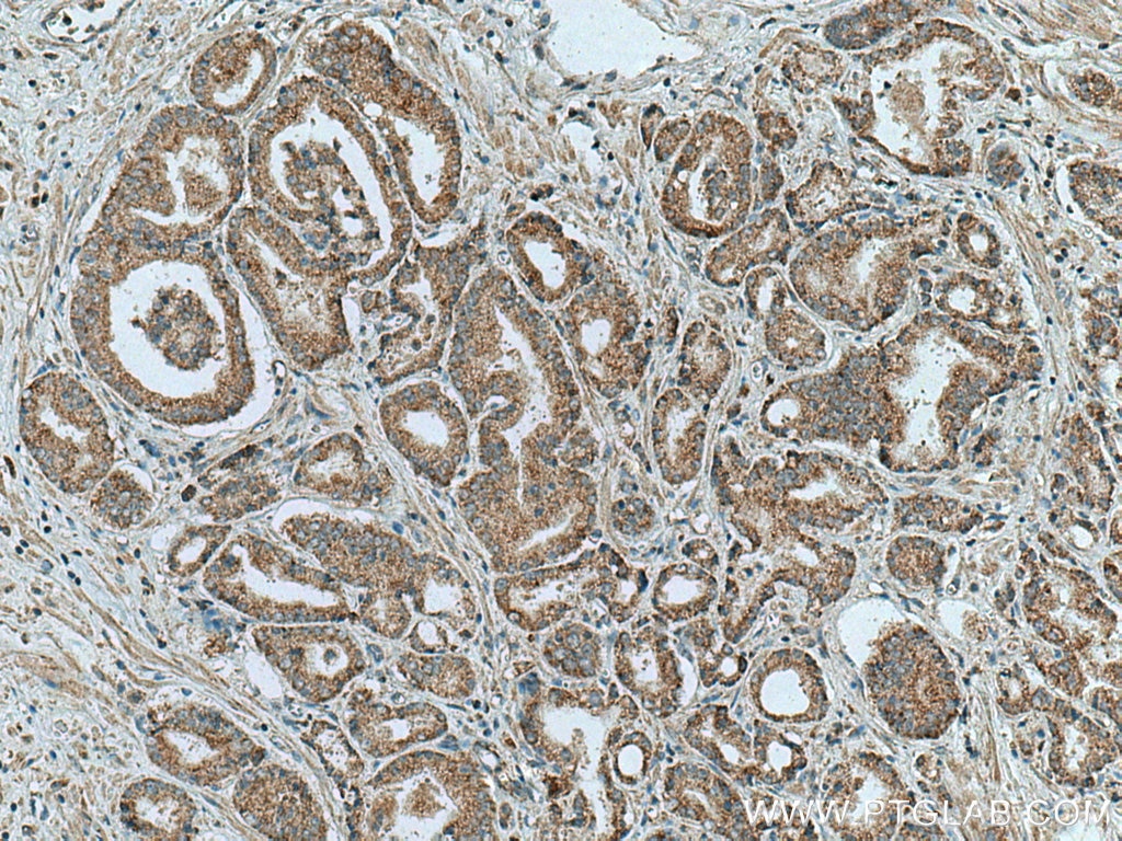 Immunohistochemistry (IHC) staining of human prostate cancer tissue using NDUFB3 Polyclonal antibody (12358-1-AP)
