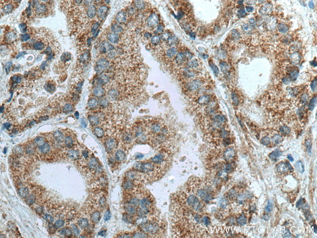 Immunohistochemistry (IHC) staining of human prostate cancer tissue using NDUFB3 Polyclonal antibody (12358-1-AP)