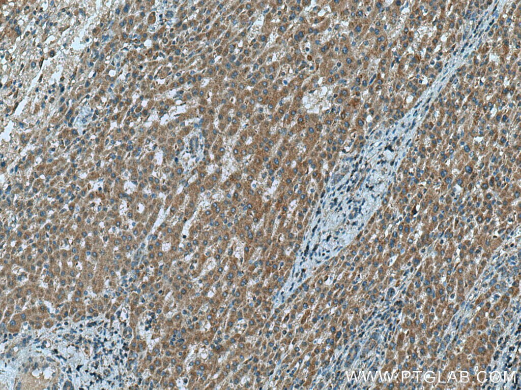 Immunohistochemistry (IHC) staining of human liver cancer tissue using NDUFB3 Polyclonal antibody (12358-1-AP)