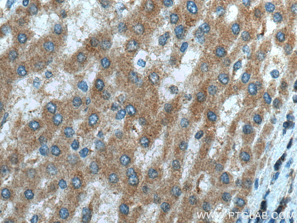 Immunohistochemistry (IHC) staining of human liver cancer tissue using NDUFB3 Polyclonal antibody (12358-1-AP)
