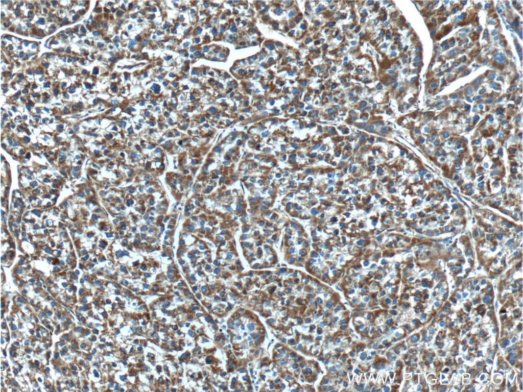 Immunohistochemistry (IHC) staining of human liver cancer tissue using NDUFB5 Polyclonal antibody (23855-1-AP)