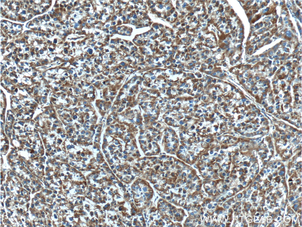 Immunohistochemistry (IHC) staining of human liver cancer tissue using NDUFB5 Polyclonal antibody (23855-1-AP)