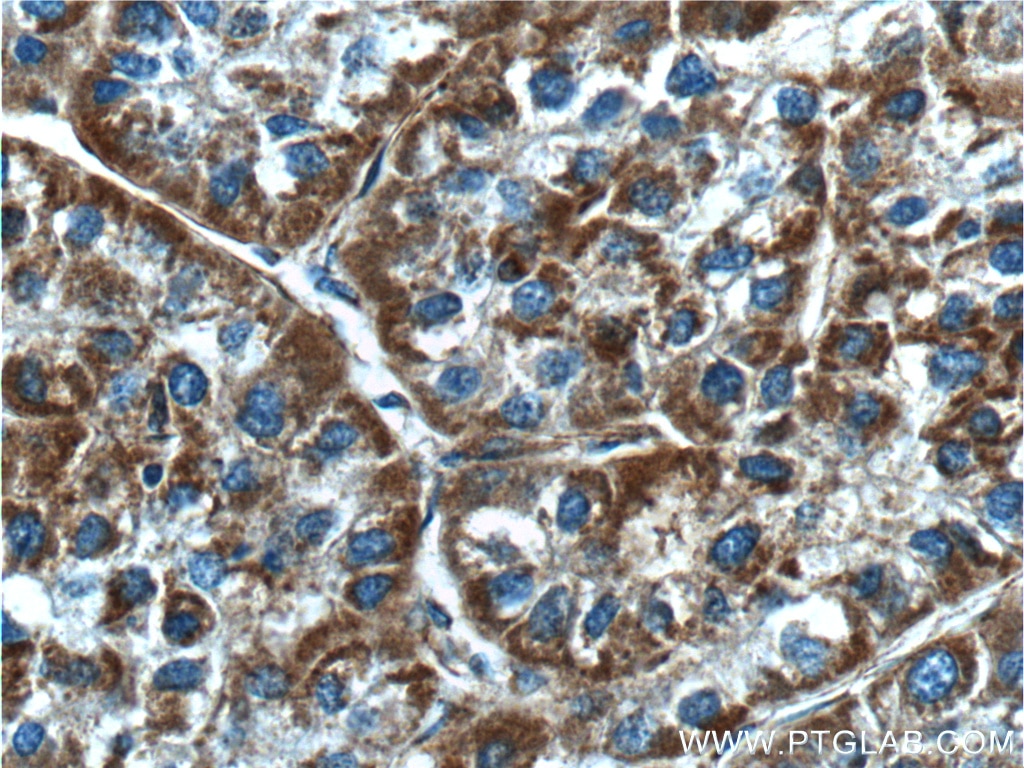 Immunohistochemistry (IHC) staining of human liver cancer tissue using NDUFB5 Polyclonal antibody (23855-1-AP)