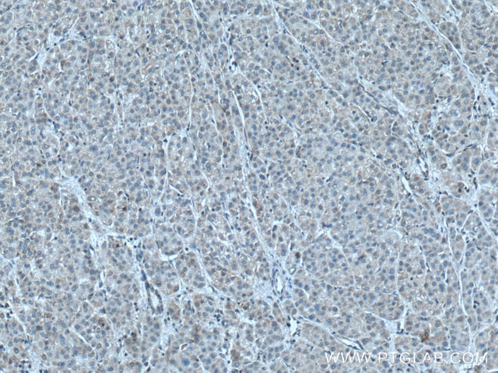 Immunohistochemistry (IHC) staining of human liver cancer tissue using NDUFB6 Polyclonal antibody (16037-1-AP)