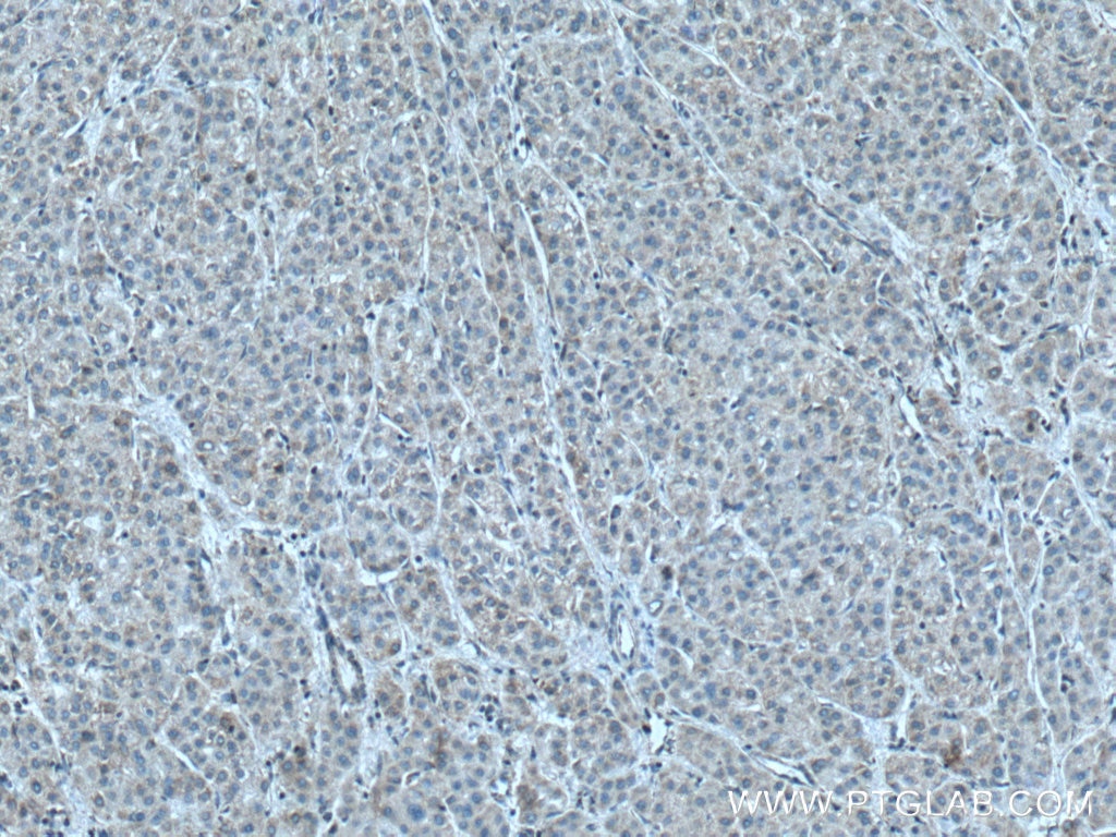 Immunohistochemistry (IHC) staining of human liver cancer tissue using NDUFB6 Polyclonal antibody (16037-1-AP)