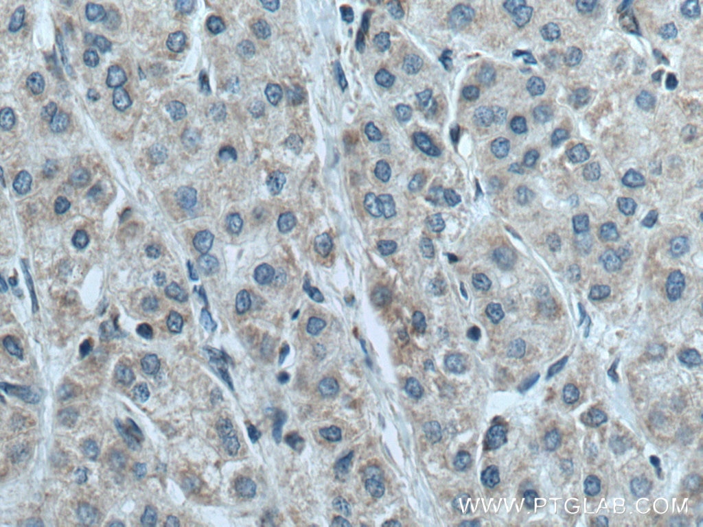 Immunohistochemistry (IHC) staining of human liver cancer tissue using NDUFB6 Polyclonal antibody (16037-1-AP)