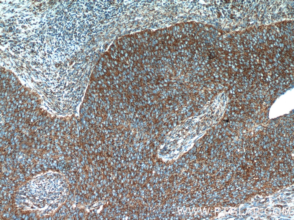 Immunohistochemistry (IHC) staining of human cervical cancer tissue using NDUFB7 Polyclonal antibody (14912-1-AP)