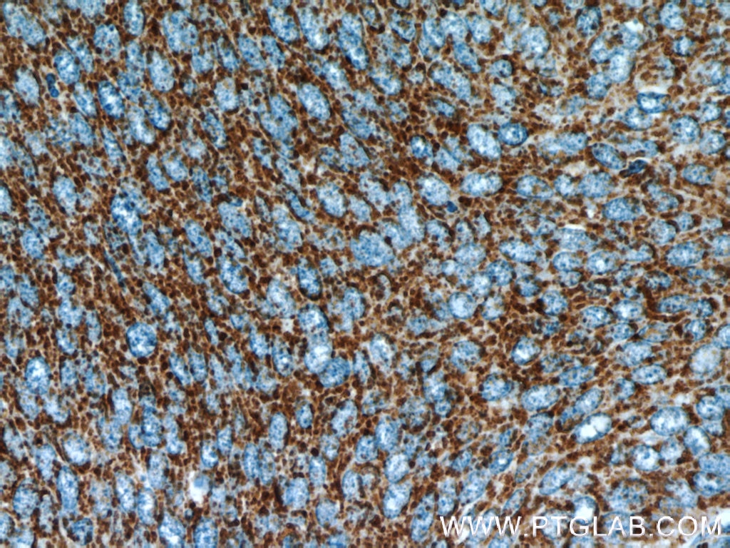 Immunohistochemistry (IHC) staining of human cervical cancer tissue using NDUFB7 Polyclonal antibody (14912-1-AP)