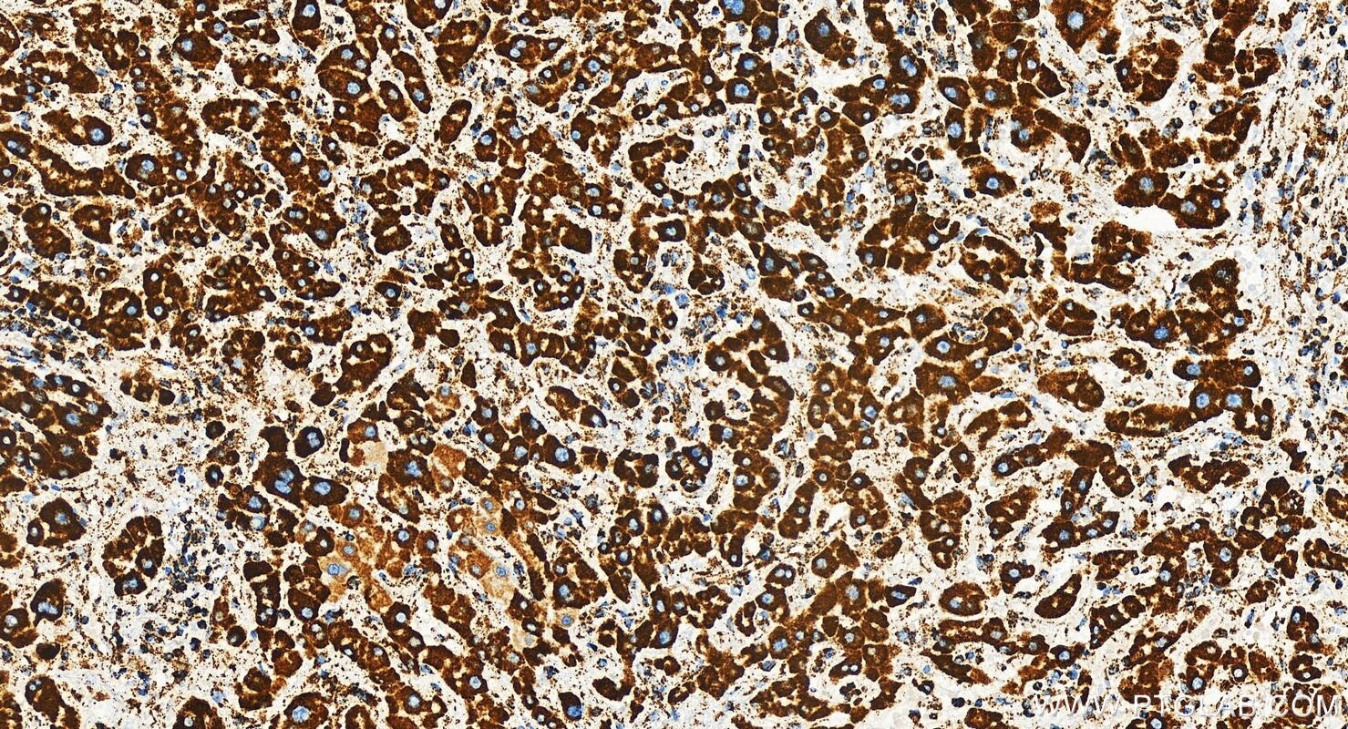 Immunohistochemistry (IHC) staining of human intrahepatic cholangiocarcinoma tissue using NDUFB8 Recombinant antibody (83216-4-RR)