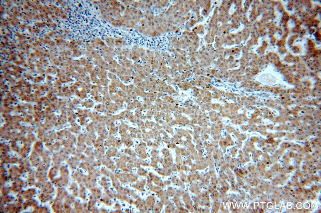 Immunohistochemistry (IHC) staining of human hepatocirrhosis tissue using NDUFC2 Polyclonal antibody (15573-1-AP)