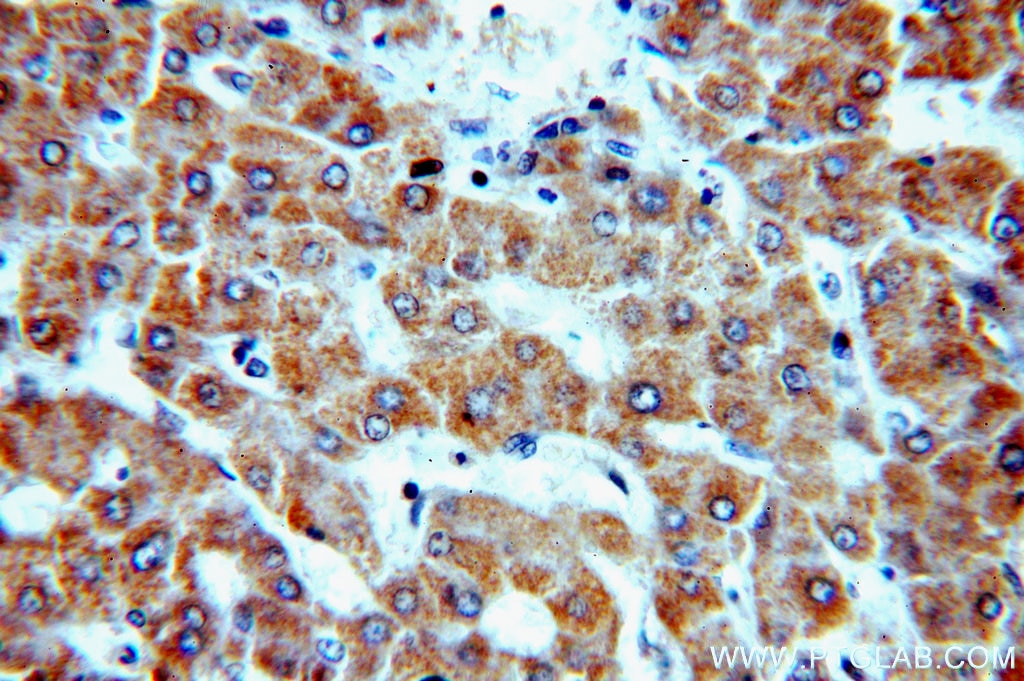 Immunohistochemistry (IHC) staining of human hepatocirrhosis tissue using NDUFC2 Polyclonal antibody (15573-1-AP)