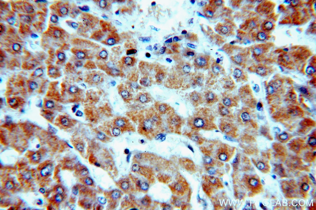 IHC staining of human hepatocirrhosis using 15573-1-AP