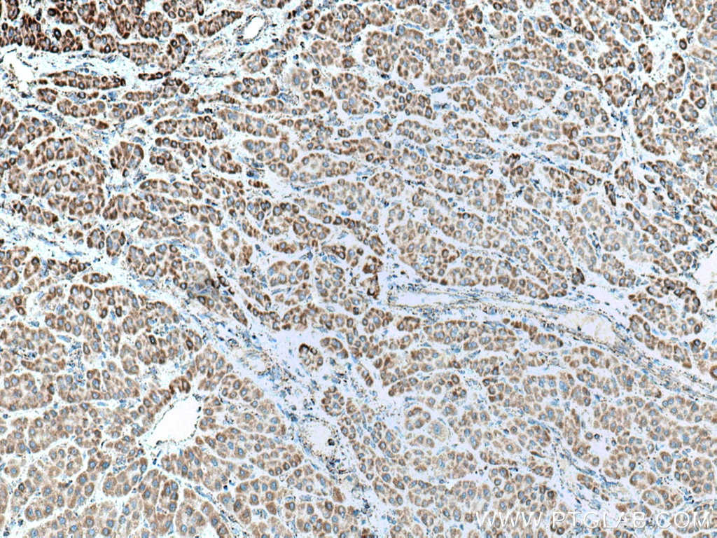 Immunohistochemistry (IHC) staining of human liver cancer tissue using NDUFS1 Polyclonal antibody (12444-1-AP)