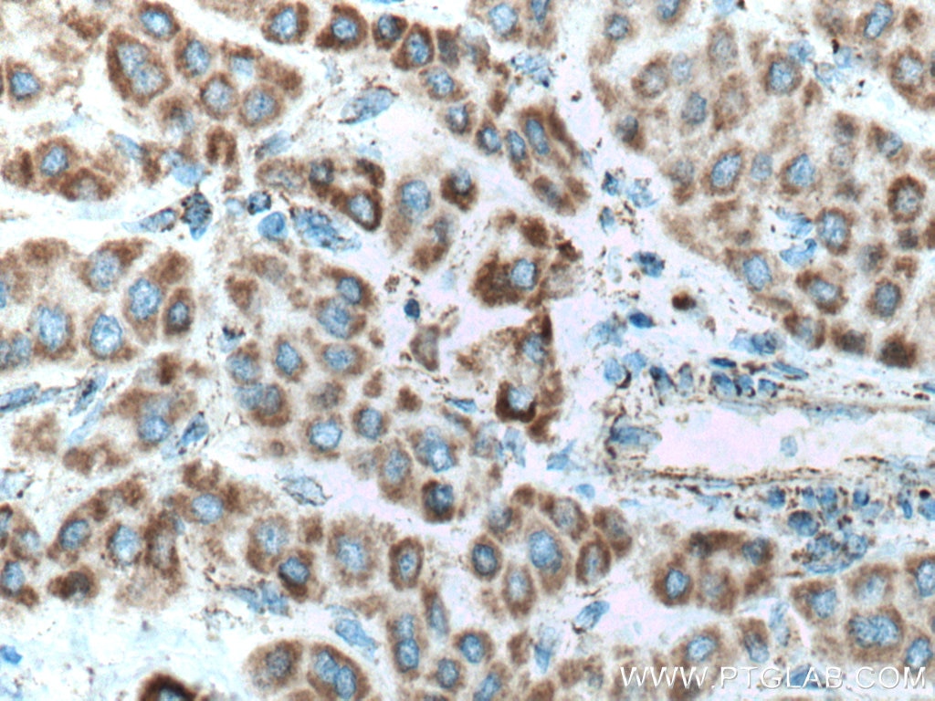 Immunohistochemistry (IHC) staining of human liver cancer tissue using NDUFS1 Polyclonal antibody (12444-1-AP)