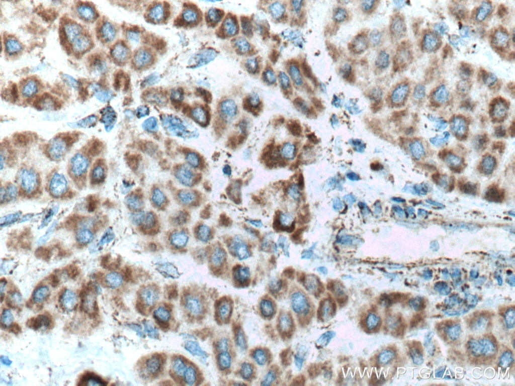 IHC staining of human liver cancer using 12444-1-AP