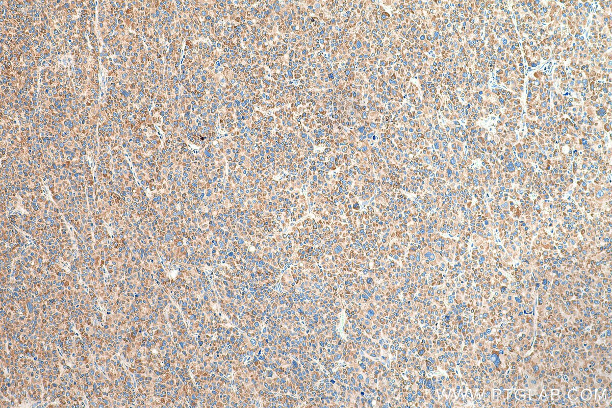 Immunohistochemistry (IHC) staining of human liver cancer tissue using NDUFS1 Polyclonal antibody (12444-1-AP)